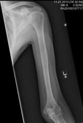 Shoulder Pain in Man Hospitalized for Brain Mass