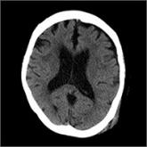 Confusion recurs 2 weeks after fall