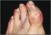Managing gout: There’s more we can do
