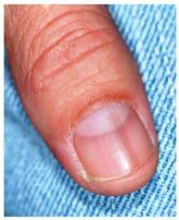 Diagnosing a Sun Exposed Thumbnail