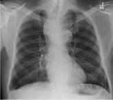 Cough and Back Pain in a Man With COPD