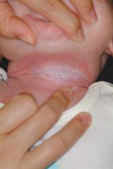 Infant with Unrelenting Rash