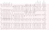 Basketball Player with Continuous Palpitations