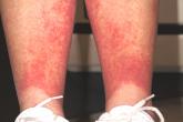 Rash Emerges After 18 Holes of Golf