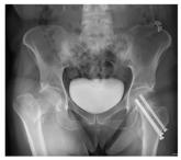 Woman With Hip Pain After Car Accident