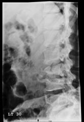 Man with Debilitating Back Pain