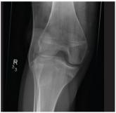 Chest Wall and Knee Pain Following Motor Vehicle Collision