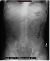 Dehydration Leads to Incidental Finding