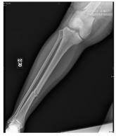 Woman with Abdominal Pain Following Severe Car Crash