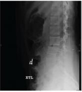 Severe Pain Following Car Crash