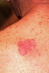 It "Must" Be a Fungal Infection—Right?