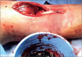 Acute Compartment Syndrome Following Distal Biceps Tendon Rupture in an Otherwise Healthy Male