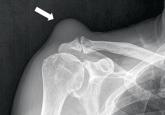 Complicated Acromioclavicular Joint Cyst With Massive Rotator Cuff Tear 