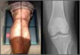Tip of the Iceberg: Subtle Findings on Traumatic Knee Radiographs Portend Significant Injury