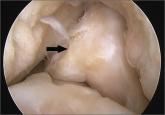 Meniscal Root Entrapment of an Osteochondritis Dissecans Loose Body