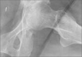 Eikenella corrodens Septic Hip Arthritis in a Healthy Adult Treated With Arthroscopic Irrigation and Debridement