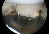 Patellofemoral Crepitation and Clunk Complicating Posterior-Stabilized Total Knee Arthroplasty