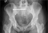 The Role of Computed Tomography for Postoperative Evaluation of Percutaneous Sacroiliac Screw Fixation and Description of a “Safe Zone”