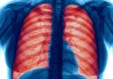 Which patients with respiratory disease need long-term azithromycin?