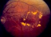 Rate of visual impairment up 21%; diabetes is likely culprit