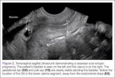 My Most Unusual Case: Cesarean Scar Ectopic Pregnancy