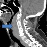 Retropharyngeal Hematoma in a 90-Year-Old Woman