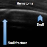 Identifying Pediatric Skull Fracture Using Point-of-Care Ultrasound