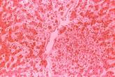 Tetravalent dengue vaccine shown to be effective and safe in children