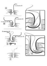 Simple technique facilitates laparoscopic port closure