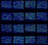 Microarray is ‘go-to’ test for multiple congenital anomalies 