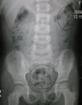 X-Ray Illustrates Constipation Pain for Parents