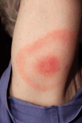 Reinfection, Not Relapse, Likely Spurred Lyme Recurrence
