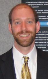 Recent knee injuries spark rapid cascade to joint failure