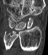 MRI score of joint narrowing has research promise