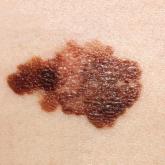 Melanoma increases in adolescents 
