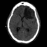 Hemodynamic complications commonly found in veterans after TBI