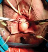 The new anterior repair