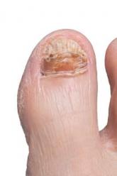 Topical efinaconazole permeates nail to infection