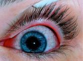 Isotretinoin Users Need Eye Drop Prescription