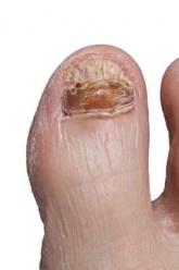 New onychomycosis drugs show similar success and side effects