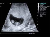 Identify monochorionic twins to guide pregnancy management