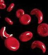 NHLBI Expert Panel Issues Guideline on Sickle Cell Disease