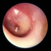 Tympanic membrane now keys otitis media diagnosis