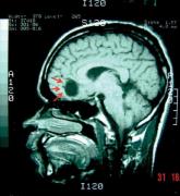 New guideline tries to rein in neurocysticercosis treatment controversy