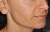 Laser settings tested against melasma