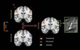 Cortical Thickening Observed in Patients With Frequent Migraines
