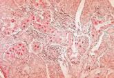 Immune globulin may not block intrauterine CMV transmission