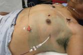 Pigtail catheters less painful than chest tubes for traumatic pneumothorax