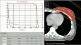 Heart irradiation is lower with contemporary breast radiotherapy