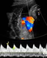 Get umbilical artery systolic-to-diastolic ratio in intrauterine growth restriction